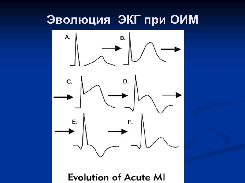 Эволюция  ЭКГ при ОИМ